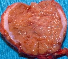 PARATHYROID CARCINOMA