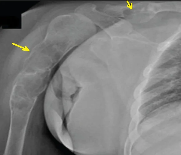 PARATHYROID ADENOMA - BROWN TUMORS