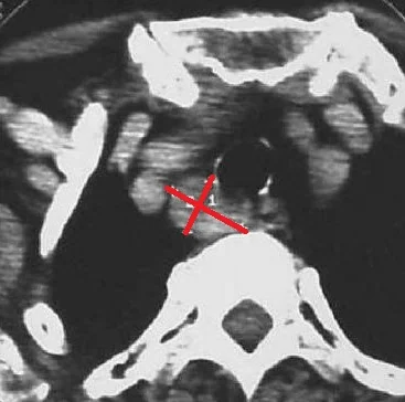 PARAESOPHAGEAL PARATHYROID ADENOMA