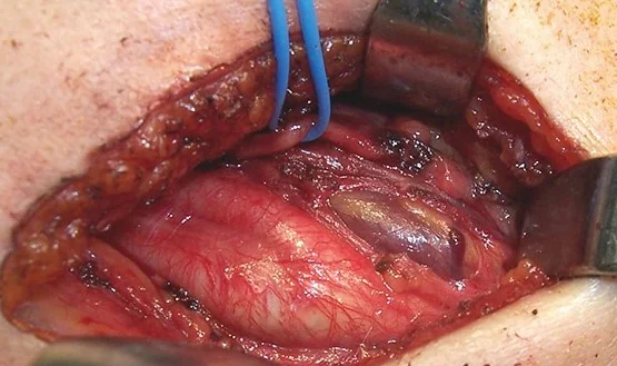 UNDESCENDED PARATHYROID ADENOMA - CAROTID BIFURCATION