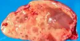 PARATHYROID ADENOMA
