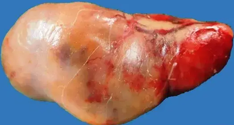 PARATHYROID ADENOMA