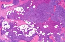 PARATHYROID ADENOMA