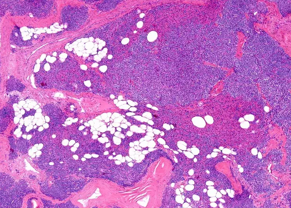 PARATHYROID ADENOMA