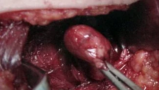 PARATHYROID ADENOMA