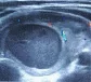 PARATHYROID ADENOMA
