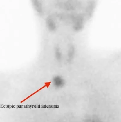 ECTOPIC PARATHYROID ADENOMA