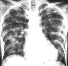 PARATHYROID CARCINOMA - PULMONARY METASTASES