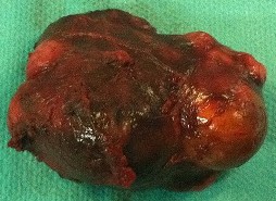 PARATHYROID CARCINOMA
