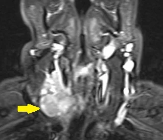 PARATHYROID CARCINOMA