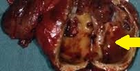 PARATHYROID CARCINOMA
