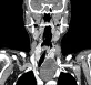 PARATHYROID CYST