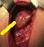 PARATHYROID CYST