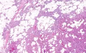 PARATHYROID LIPOADENOMA