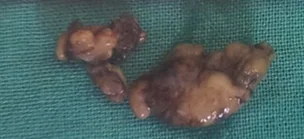 PARATHYROID LIPOADENOMA .(Courtesy Dr. V . Penopoulos).