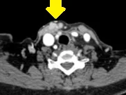 SUBCUTANEOUS PARATHYROMATOSIS