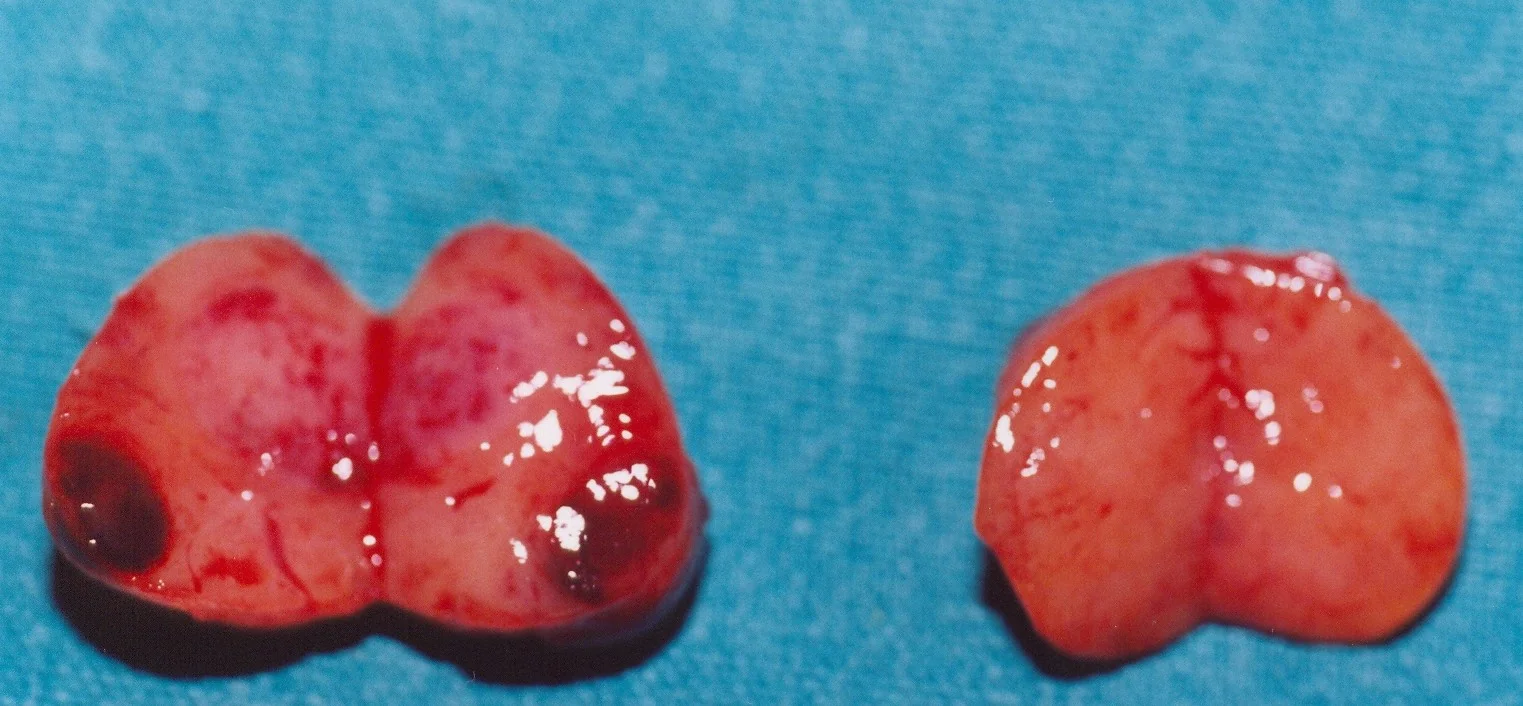 SYNCHRONOUS PARATHYROID ADENOMAS