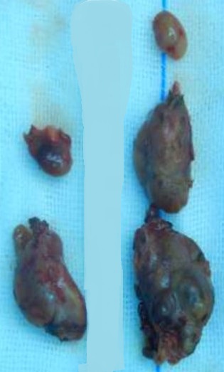PARATHYROID HYPERPLASIA