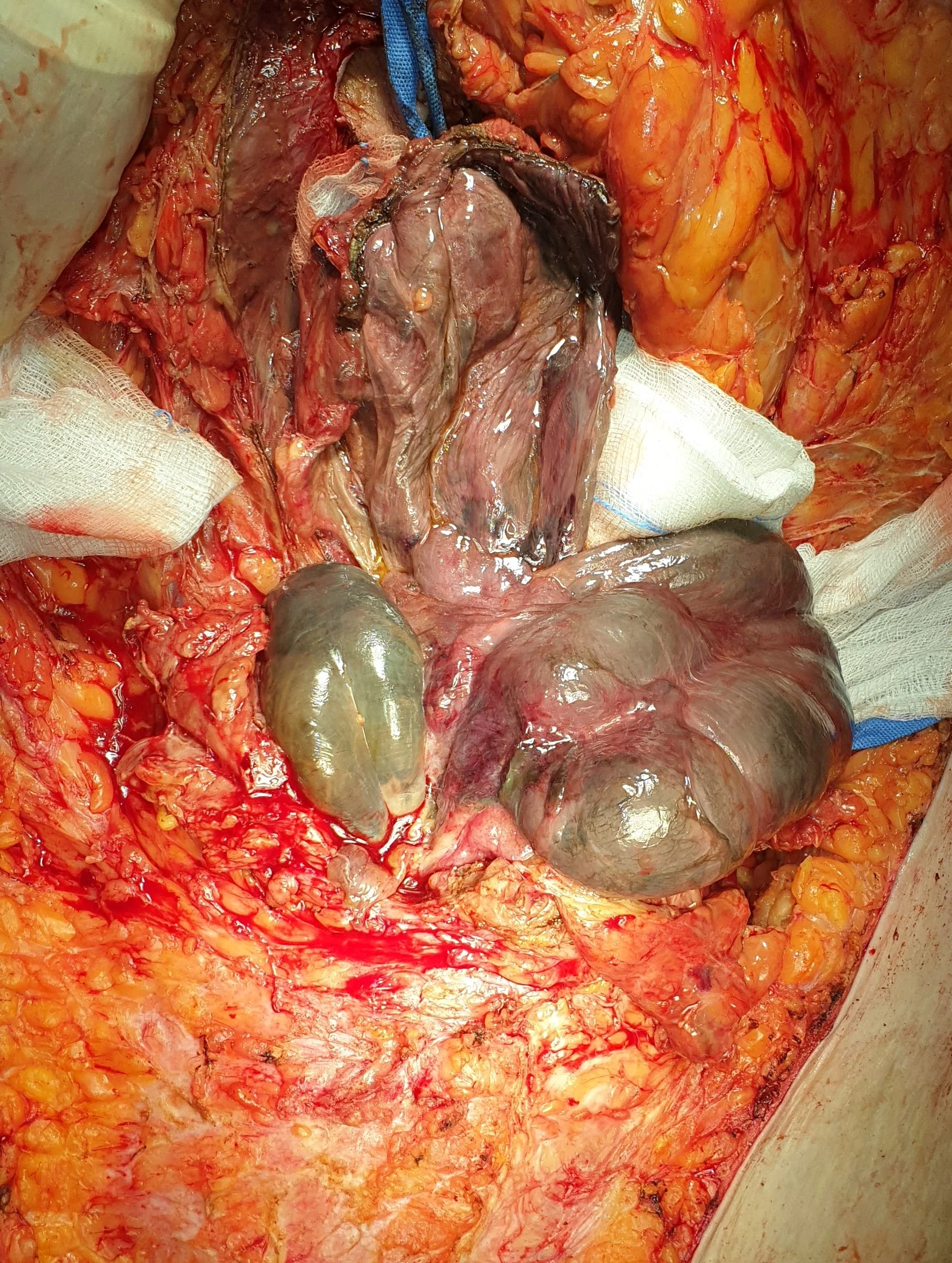 STRANGULATED INCISIONAL HERNIA - NECROTIC BOWEL