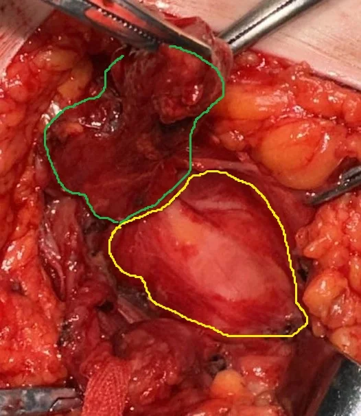 SYNCHRONOUS INDIRECT + DIRECT HERNIAS