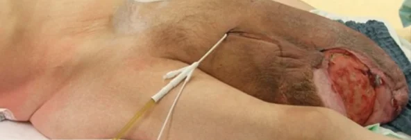 GIANT INGUINOSCROTAL HERNIA