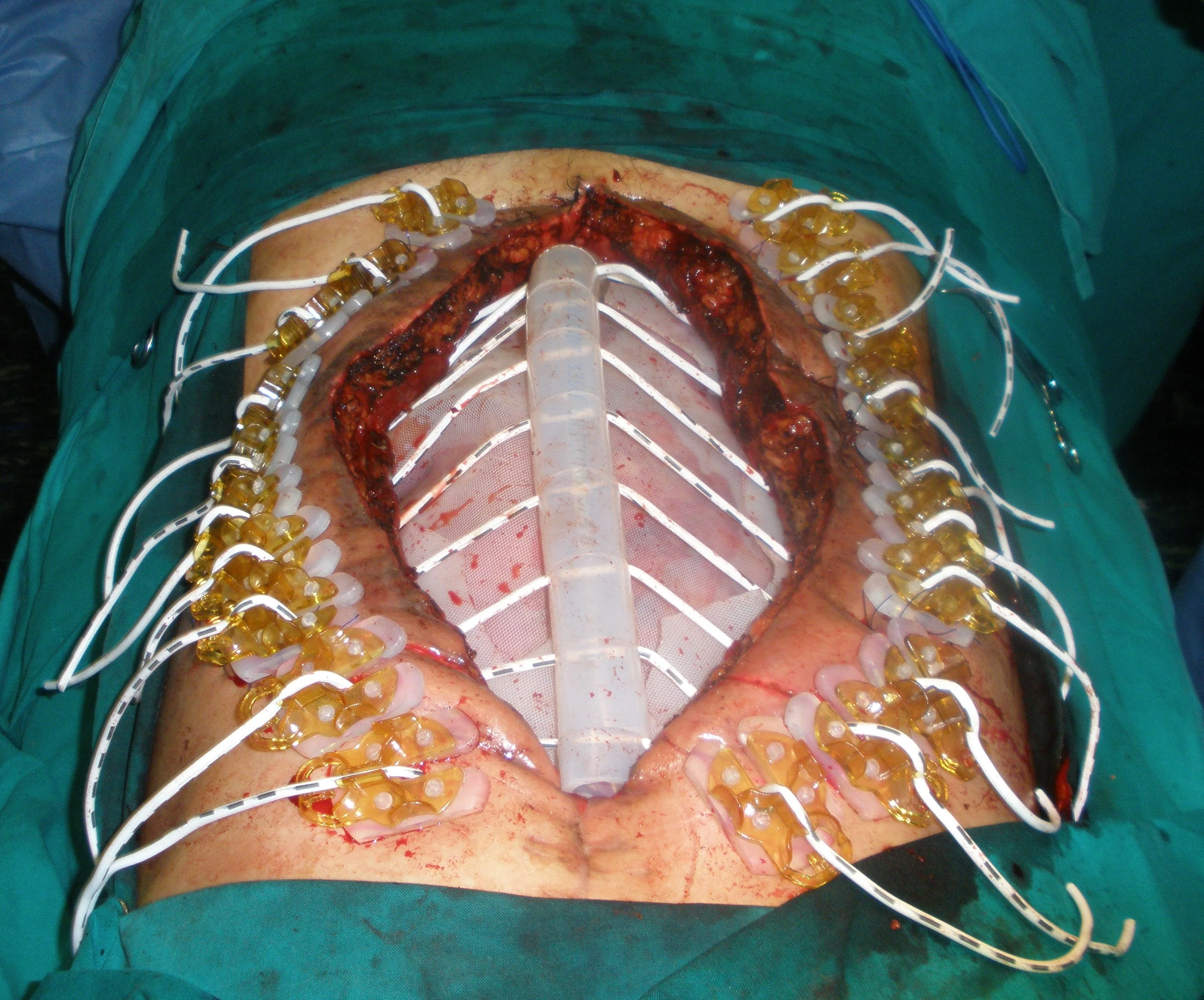 RECURRENT ABDOMINAL HERNIA REPAIR