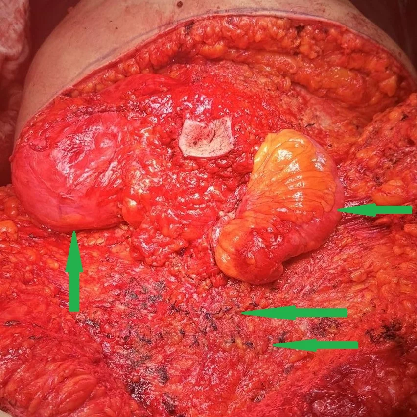 MULTIPLE ABDOMINAL HERNIAS