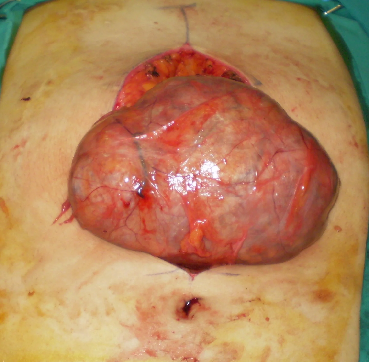 SPIGELIAN HERNIA