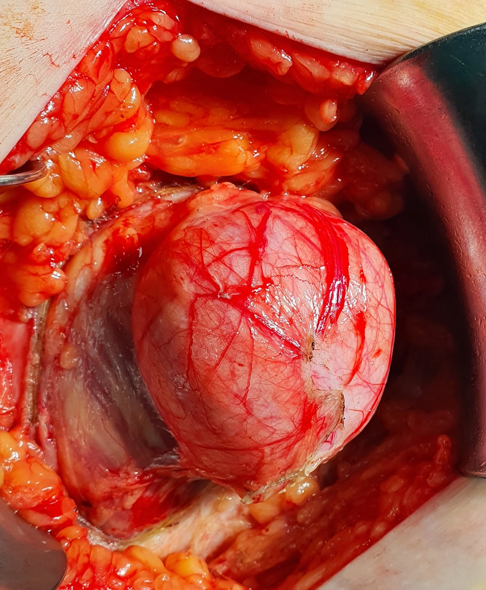 SPIGELIAN HERNIA