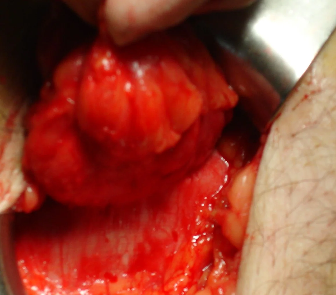SPIGELIAN HERNIA
