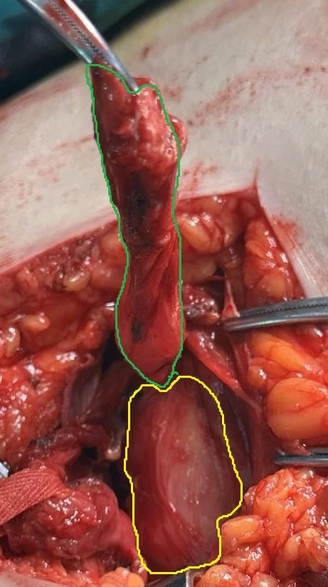 INGUINAL HERNIA - DISSECTION OF HERNIAL SAC