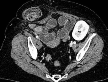 STRANGULATED HERNIA