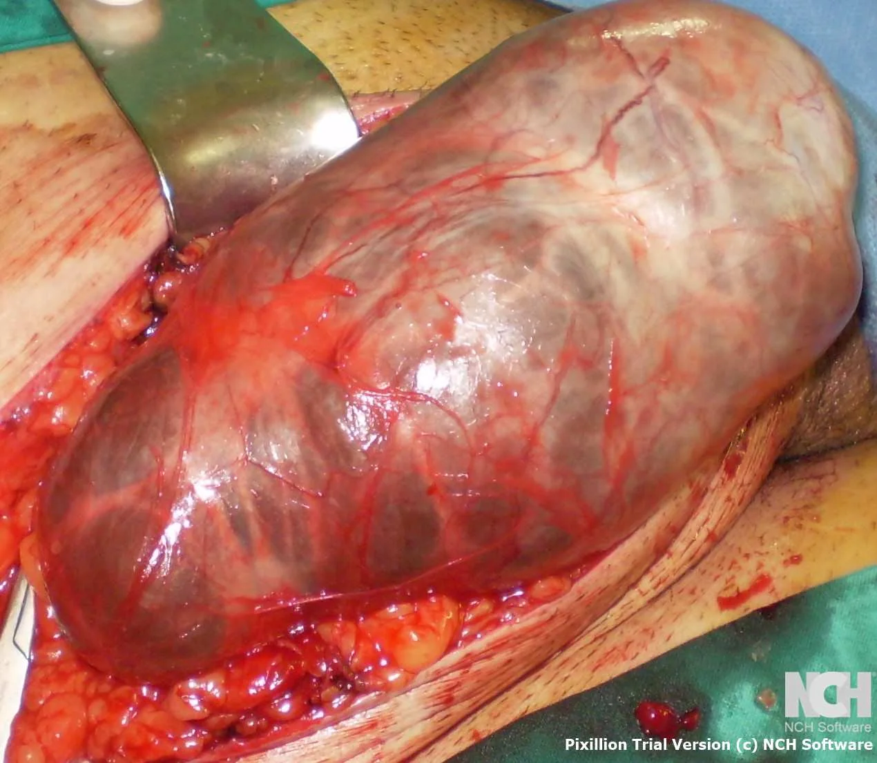 SYNCHRONOUS INGUINAL HERNIA + HYDROCELE