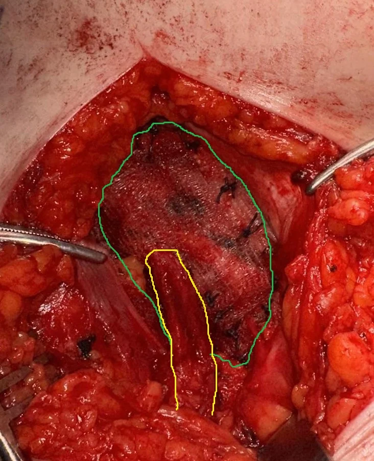 NO TENSION INGUINAL HERNIA REPAIR WITH MESH