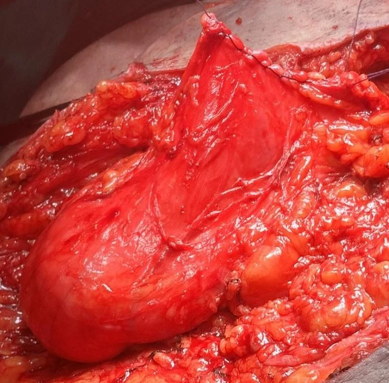 SIZEABLE HERNIAL SAC