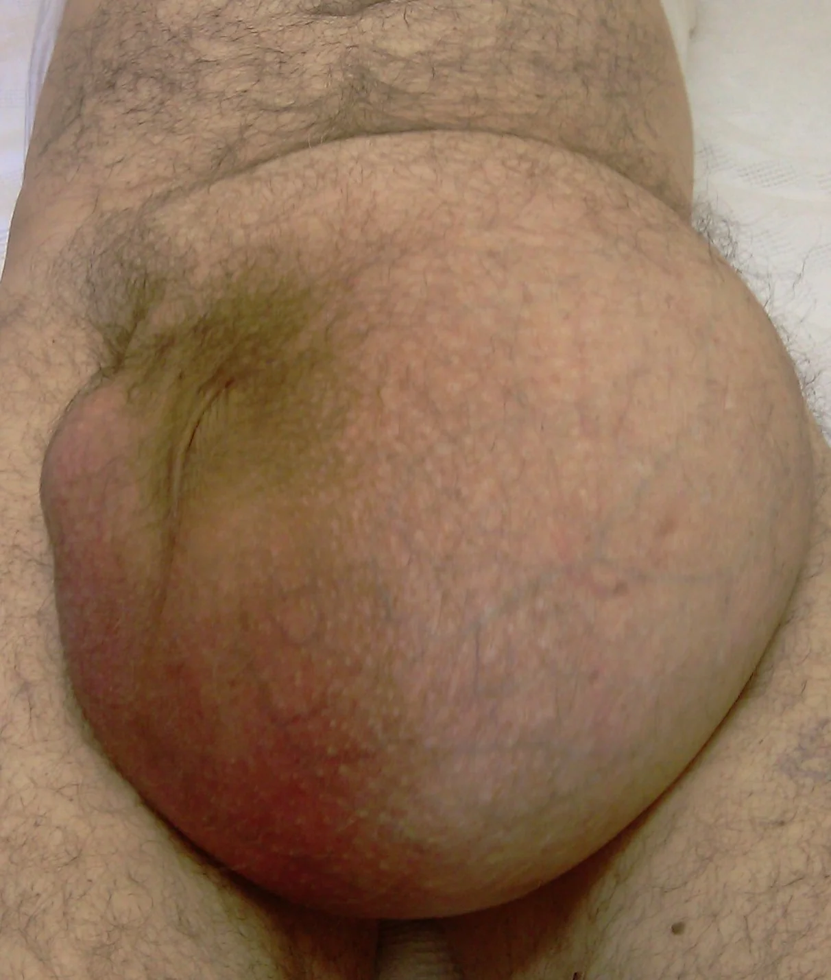 ENORMOUS INGUINAL HERNIA 