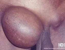 FEMORAL HERNIA