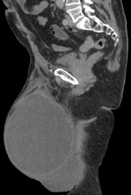 GIANT INGUINOSCROTAL HERNIA  - POST OP SEROMA