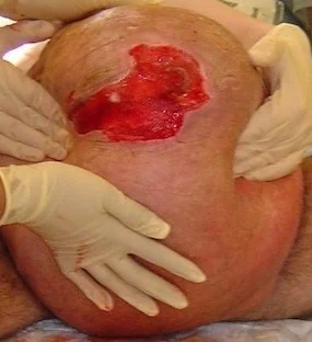 GIANT INGUINOSCROTAL HERNIA - SCROTAL ULCER