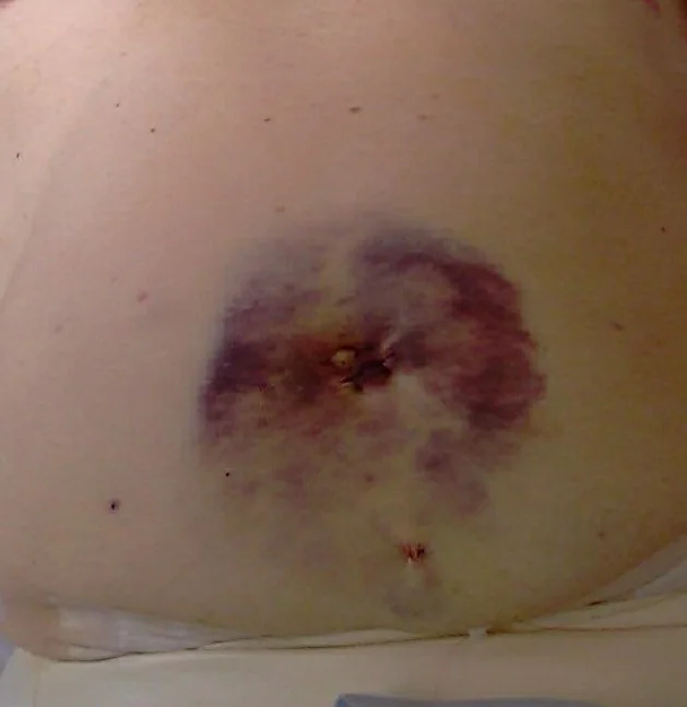 POST INGUINAL HERNIA REPAIR HEMATOMA