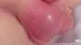 INFLAMMED INGUINAL HERNIA