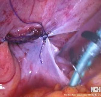 INGUINAL HERNIA REPAIR
