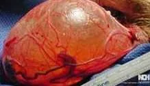 HYDROCELE