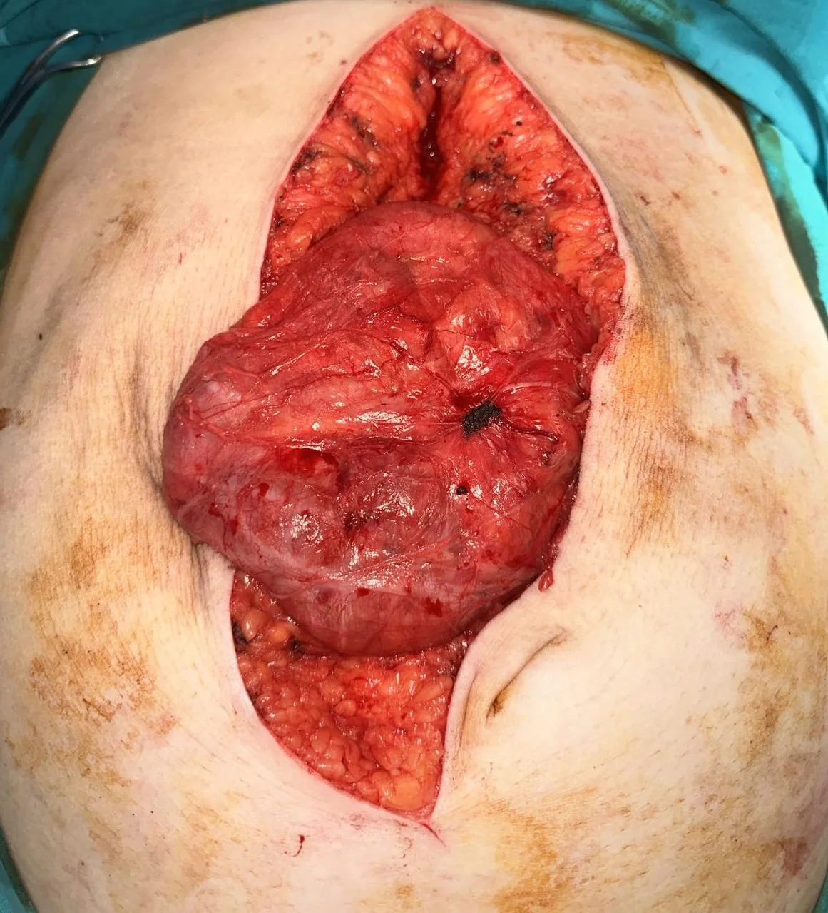 INCISIONAL HERNIA