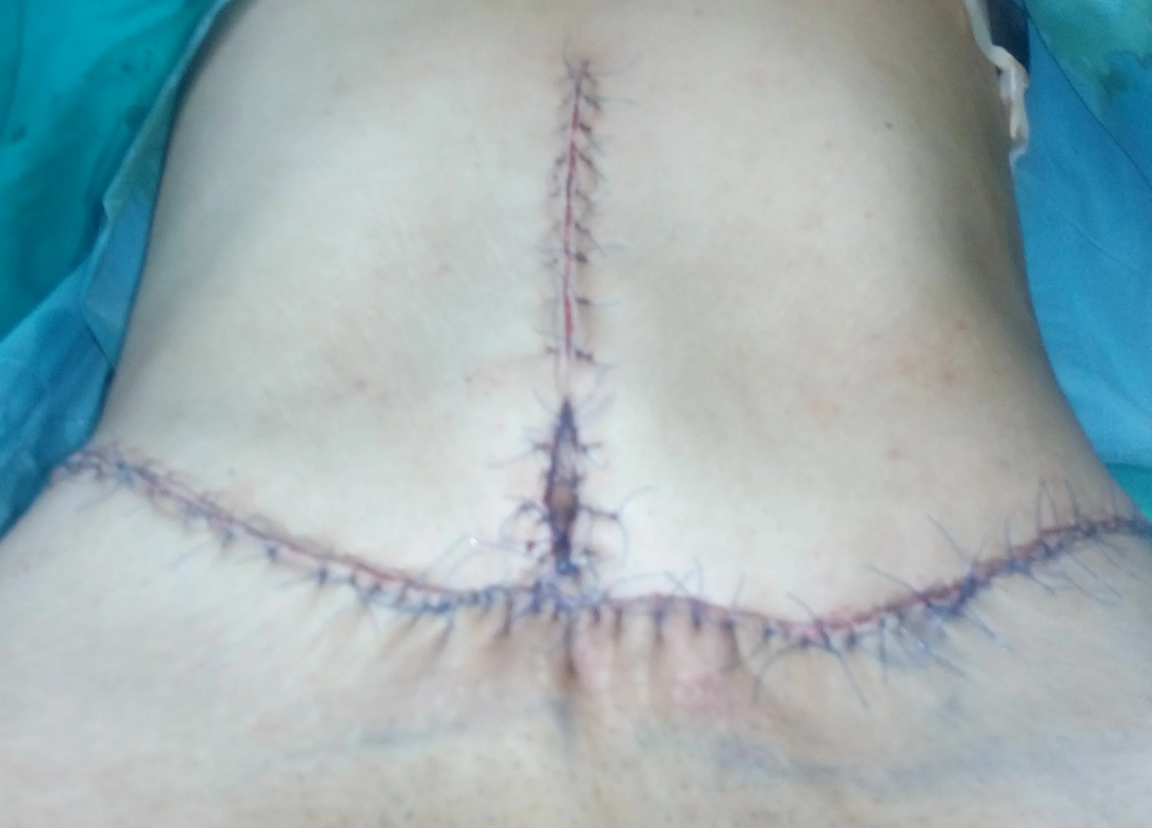 LIPOPLASTY