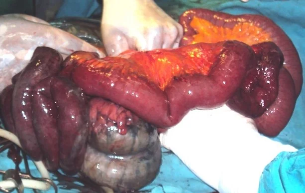 STRANGULATED INCISIONAL HERNIA - NECROTIC BOWEL