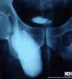 INGUINAL HERNIA - BOWEL IN THE CANAL