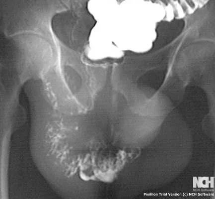 INGUINAL HERNIA - BOWEL IN THE SCROTUM