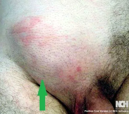 INGUINAL HERNIA
