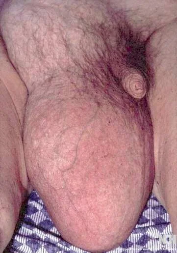 SIZEABLE INGUINOSCROTAL HERNIA